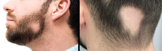Alopecia ou calvície  - pode surgir como uma falha na barba ou no cabelo.