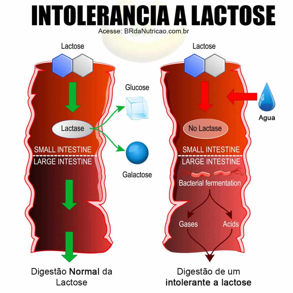 o que é intolerancia a lactose sintomas 